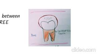 Dentigerous Cyst  Pathogenesis [upl. by Drislane]