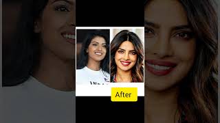 Bollywood actress Before and after surgery 😮😮🇮🇳🇮🇳bollywood viralshort youtubeshorts shorts [upl. by Airdnek588]