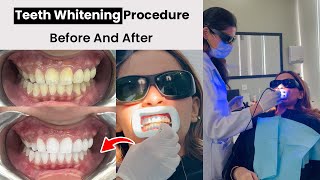 Teeth Scaling Polishing and Whitening Procedure Step By Step  Female Dentist in Lahore [upl. by Nuahsad]