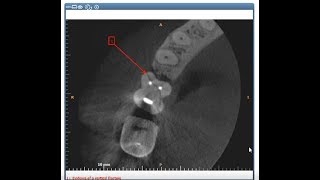 Carestream 3D Imaging  Creating Arrows and Annotations [upl. by Wojcik]