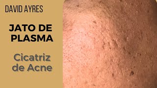 Tratamento para cicatriz de acne com Jato de Plasma [upl. by Akihsar]