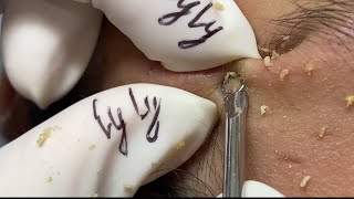 99 2024 Acne Treatment for “ MAI ANH” part 1  LyLyBeautySpa [upl. by Adnahsam]