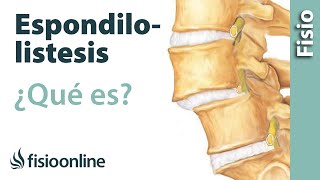 Espondilolistesis  ¿Qué es [upl. by Trescha]