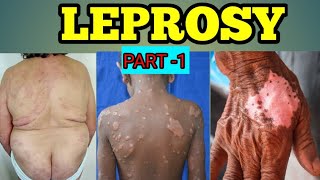 LEPROSY Full Animation 3D video leprosydiseaseskininfectionbiologymedicinembbsmedicalbio [upl. by Eilyah]