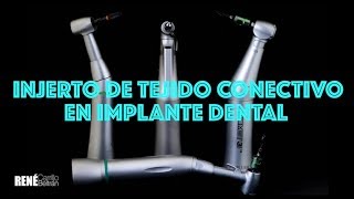 Injerto de Tejido Conectivo en implante dental DIO [upl. by Melton290]