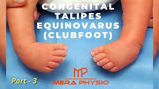 Congenital Talipes Equinovarus Clubfoot  pt 3  Physiotherapy Treatment  In Hindi  Mera Physio [upl. by Shalna]