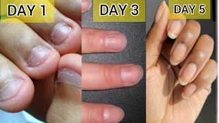 🔴कितने भी खराब नाखून हो बस 5 दिन में सुंदर लम्बे होंगे💅🌿GROW NAILS FASTER AT HOME🔴 [upl. by Pentheam]