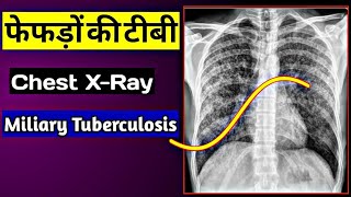 Chest XRay Normal vs TB Positive  Miliary Tuberculosis  Uday XRay [upl. by Delmor]