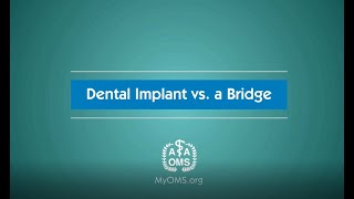 Dental Implant vs a Bridge [upl. by Grath190]