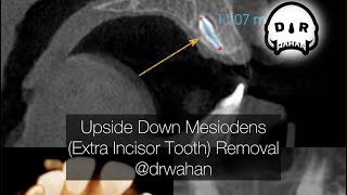 Black and White Version Palatal Mesiodens Removal drwahan [upl. by Nitsyrk]