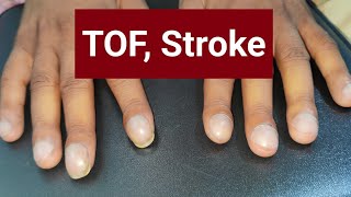 Tetralogy of Fallot Stroke Nail Clubbing [upl. by Dadinirt]