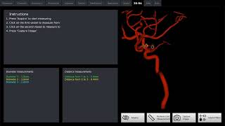 NV  Connect Intracranial Artery Stenosis [upl. by Ellynn526]