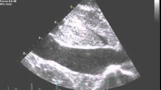 TTE Normal Subcostal IVC FULLCOLLAPSE on SNIFF Example 1 [upl. by Hplar]