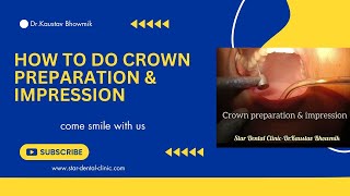 How to do crown preparation amp impression [upl. by Traggat]