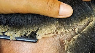 Combing And Scratching Dandruff Off Scalp Part 1 1175 [upl. by Bela]