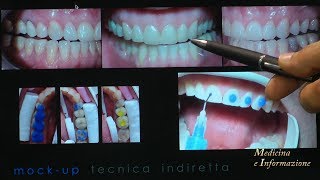 Odontoiatria Estetica Faccette le ultime novità di materiali e tecniche [upl. by Dnamron859]