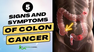 5 Signs and Symptoms of Colon Cancer [upl. by Rednal346]