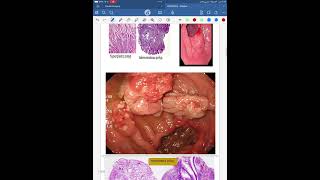 Gastric tumours pathology [upl. by Auberbach800]