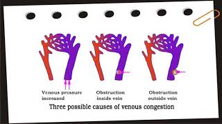 Hyperemia and Congestion [upl. by Domonic]