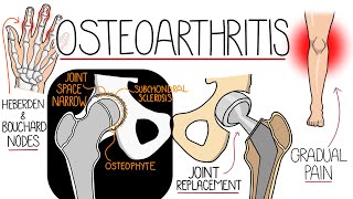 Osteoarthritis Explained Clearly [upl. by Anivahs]