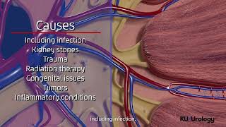 Ureteral Stricture  KU Urology [upl. by Gnirol]