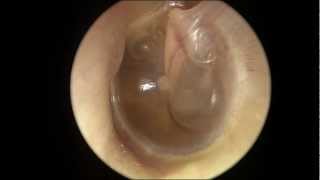 Serous Otitis Media [upl. by Hcahsem356]