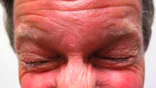 What is Blepharospasm Symptoms Causes Treatment [upl. by Papst340]