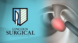 Polyp Removal  Dr Deirdre Hart Colon and Rectal Surgeon  Lincoln Surgical Associates Shiloh IL [upl. by Ennairrac616]