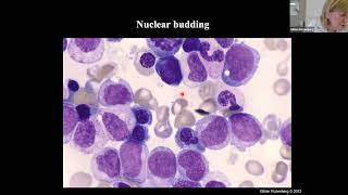 WHO Classification of Myelodysplastic Syndromes [upl. by Cj]