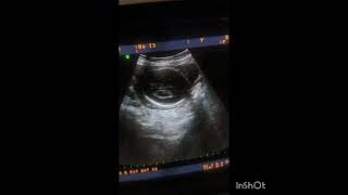 ultrasound video shows Ventriculomegaly [upl. by Weinrich]