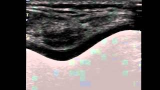 Musculoskeletal Ultrasound Knee 6 Suprapatellar Transverse Scan in Maximal Flexion [upl. by Lubow]