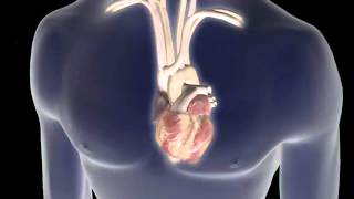 Atrial Fibrillation AFib Animation [upl. by Otrebilif]