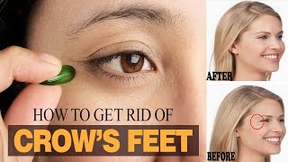 How to Get Rid of Crow’s Feet without Botox  Home Remedies for Crows Feet [upl. by Hux]