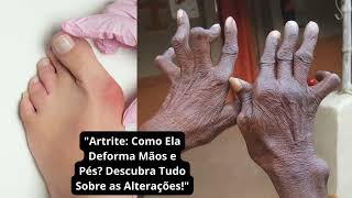 Artrite Como Ela Deforma Mãos e Pés Descubra Tudo Sobre as Alterações [upl. by Primrosa]