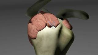 Rotator Cuff Tears [upl. by Bald527]