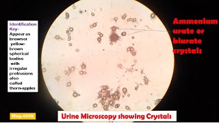 Ammonium biurate Crystals in Urine [upl. by Marlin]