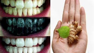 सिर्फ 2 मिनटों में पीले गंदे दांतो को मोतियों की तरह सफेद बना देगा ये नुस्खा  Teeth whitening home [upl. by Nisbet]