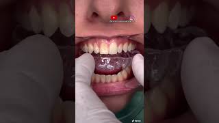 ¡🔥Instalación de férula dental🔥 [upl. by Etnelav353]