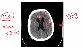 Neurology Anatomy and Physiology Part 7  Intracranial Hemorrhage Ischemic Brain DiseaseStroke [upl. by Wadesworth]