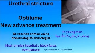 urethal stricturenew advance treatmentOPTILUMELESS RECURRENCE [upl. by Rodavlas]