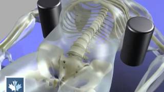 Sciatica  Spinal Decompression  Back Clinics of Canada [upl. by Odraboel]