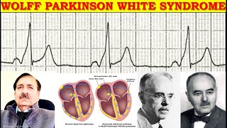 Arrhythmias associated with Wolff Parkinson White Syndrome  Lectures by Dr Alamzeb [upl. by Nnorahs]