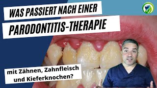 Was passiert mit Zähnen Zahnfleisch und Kieferknochen bei einer Parodontitistherapie [upl. by Uwton]