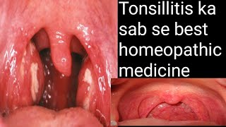 tonsillitis homoeopathic medicinetonsil homeopathy treattonsil homeopathy treatmenttonsil homeopathy [upl. by Carmel478]