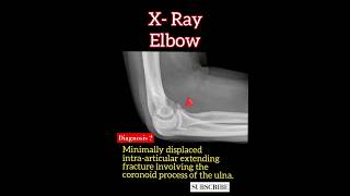 Coronoid process of the ulna fracture   Diagnosis  Radiology [upl. by Edyth]