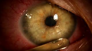 Microsporidia keratitis [upl. by Iva]