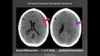 Subdural Hematoma SDH [upl. by Farkas]