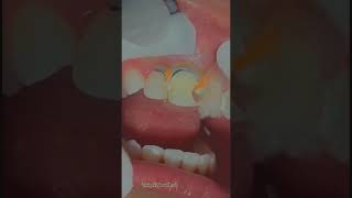 Composite restoration after Rct dentist teeth restoration composite dentis satisfying [upl. by Lotz]