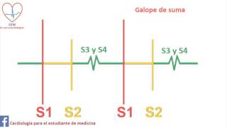 Auscultación del Galope de suma [upl. by Tosch]