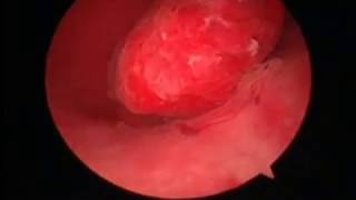 Cystoscopy  Bladder Polyp [upl. by Heiskell]